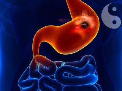 Viêm loét dạ dày – Nỗi lo của mỗi gia&nbsp;đình