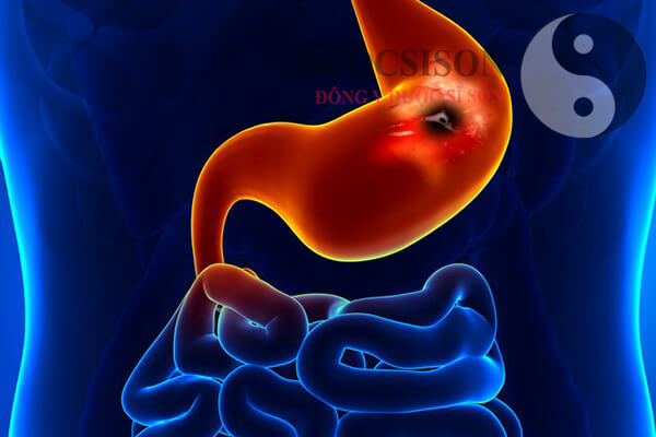 Bệnh viêm loét dạ dày